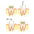 Endodoncia dental Teruel